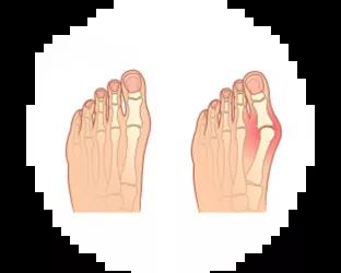 Hallux valgus fod